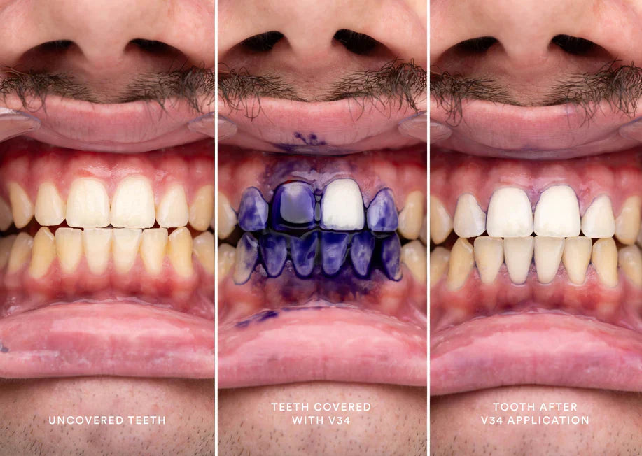 HiSmile v34 Advanced Teeth Whitening and Stains Removal Serum