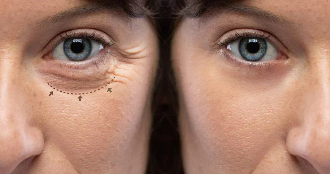 Eyelight - Say Goodbye to Dark Circles & Puffy Eyes