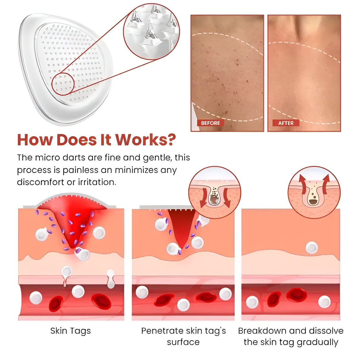 DermaSmooth - Skin Tags & Pimple Removal Patches - 72 Pieces